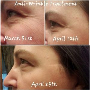 Anti Wrinkle Treatment